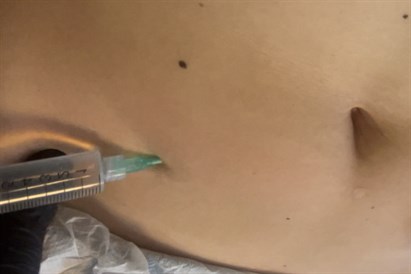 Lipoliza iniekcyjna i fale radiowe – modelowanie sylwetki w Warszawie