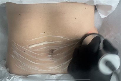 Lipoliza iniekcyjna i fale radiowe – modelowanie sylwetki w Warszawie